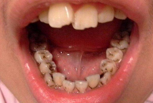 小孩牙齿上的黑点是蛀牙吗？4步教你区分！