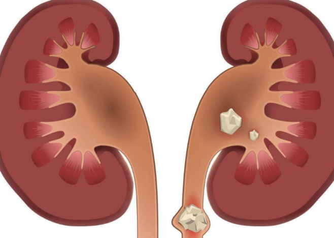 肾结石怎么快速排出?快速排出肾结石最有效的方法