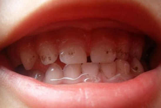 小孩牙齿上的黑点是蛀牙吗？4步教你区分！
