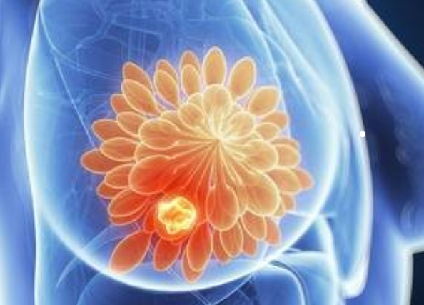 乳腺癌并非无药可救，早期筛查自检仍有治愈机会！