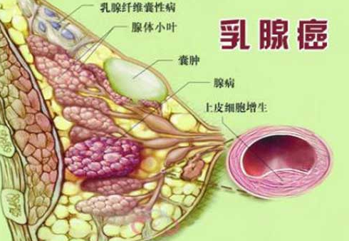 乳腺癌并非无药可救，早期筛查自检仍有治愈机会！