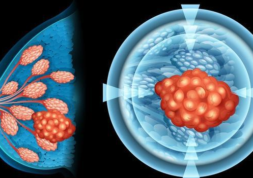 乳腺癌并非无药可救，早期筛查自检仍有治愈机会！