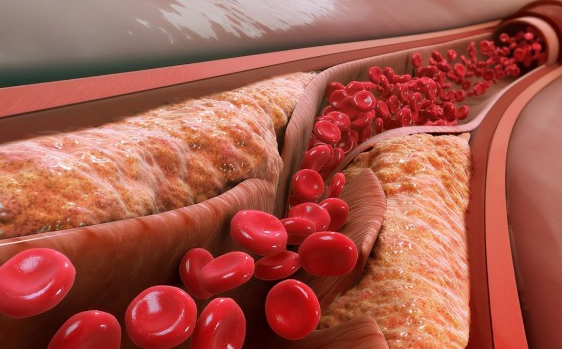 国家最新发布《中国血脂管理指南(2023)》，根据研究数据做出重大调整！