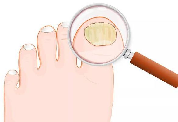 灰指甲是什么？一旦得上该如何防御和治疗？