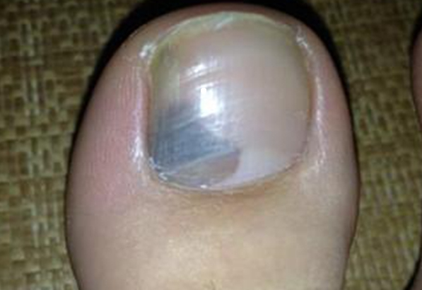 灰指甲是什么？一旦得上该如何防御和治疗？