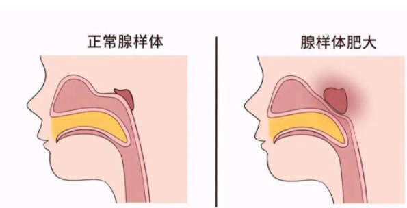 嘴凸龅牙就是腺样体面容吗?不治会不会越来越丑吗?