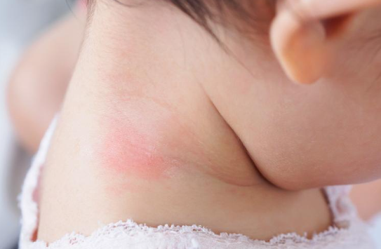 新生儿湿疹泡澡好吗（泡澡能缓解湿疹吗）