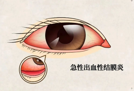 红眼病进入高发期多地疾控来提醒 小心孩子身上这些症状