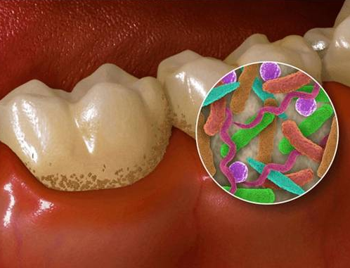 牙齿矫正期间如何控制牙菌斑?牙齿矫正期间吃香菇可以去牙菌斑吗?