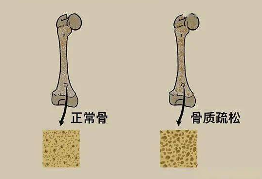 一分钟自测是否是骨质疏松，你的骨头脆脆的吗?