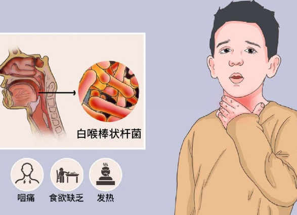 越南发生白喉疫情致1人死亡 白喉棒状杆菌主要通过飞沫传播