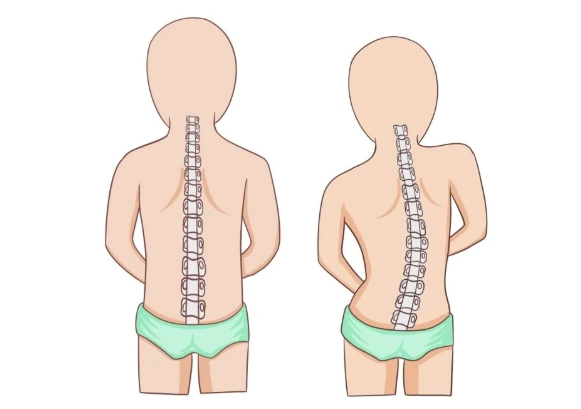 青少年脊柱侧弯患者超500万 青少年脊柱侧弯患者每年以30万人的数量递增