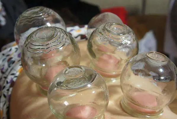 中国游泳队身上全是火罐印 拔火罐是治疗还是冒险? 中国游泳队身上全是火罐印 拔火罐是治疗还是冒险?