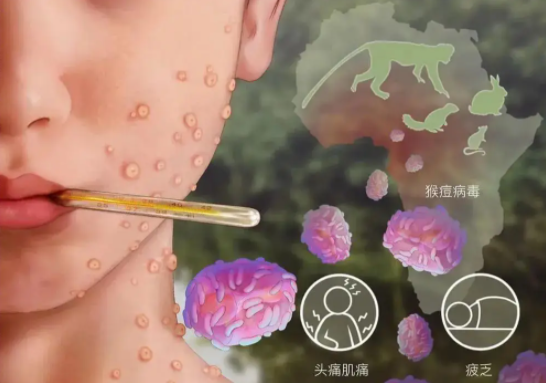 新西兰已确认53例猴痘病例!下一场疫情要来?