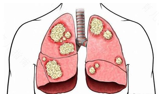 48岁刘谦自曝患肺腺癌春晚后做了手术 肺腺癌有哪些特点?