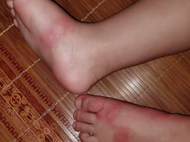 12岁小孩反复高烧竟因被毒虫咬伤 有娃却没事区别在这