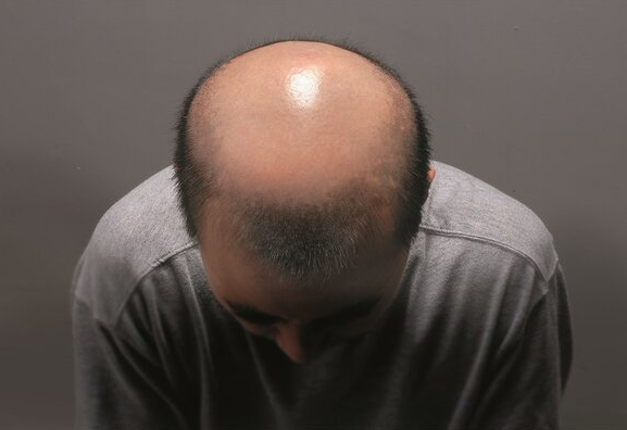 秋季脱发与甲状腺疾病有关?生活中如何预防秋季脱发?