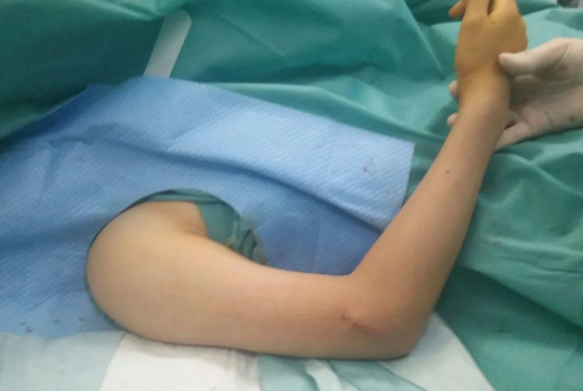 6岁萌娃骨折医生1分钟复位 小儿关节脱臼怎么分辨 6岁萌娃骨折医生1分钟复位 小儿关节脱臼怎么分辨