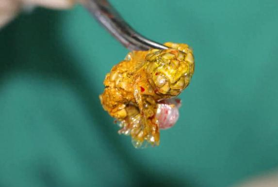 女子胆囊内竟藏400多颗结石 发病率1/10! 女子胆囊内竟藏400多颗结石 发病率1/10!