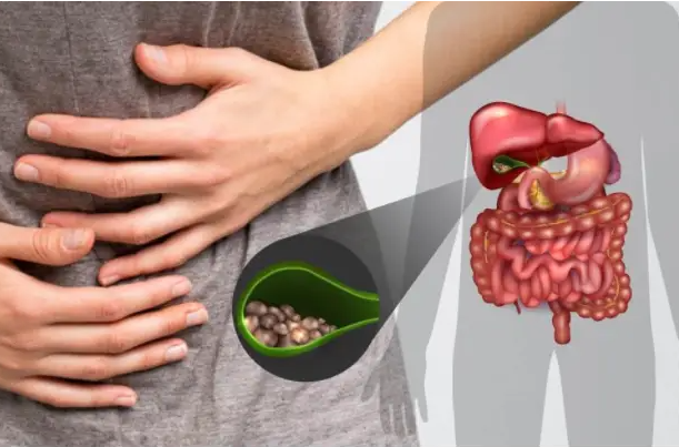 女子胆囊内竟藏400多颗结石 发病率1/10! 女子胆囊内竟藏400多颗结石 发病率1/10!