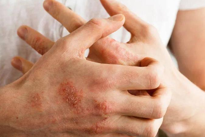 冬季乏脂性湿疹高发 洗澡请记住这组数字42 20 5 冬季乏脂性湿疹高发 洗澡请记住这组数字42 20 5