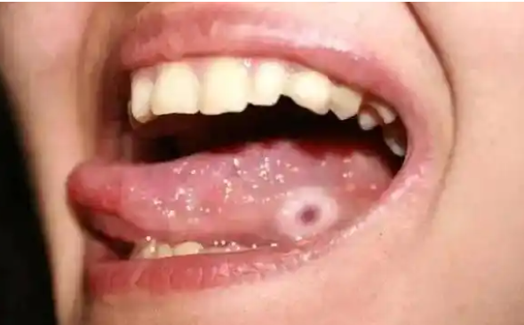 男子溃疡久不愈合查出舌癌 祸首竟然是残根残冠! 男子溃疡久不愈合查出舌癌 祸首竟然是残根残冠!