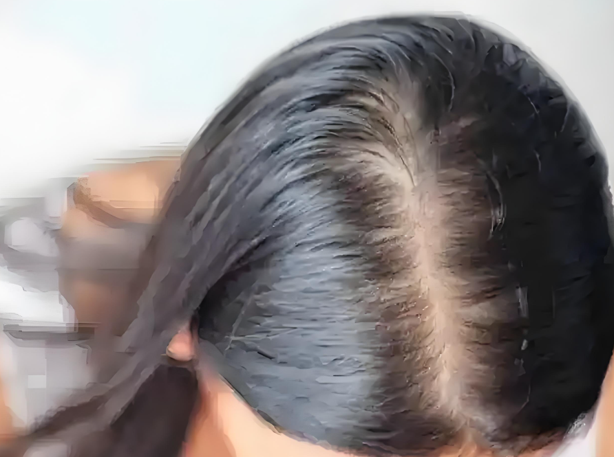 女性也会面临秃头困扰！秃头后头发还能长回来吗？