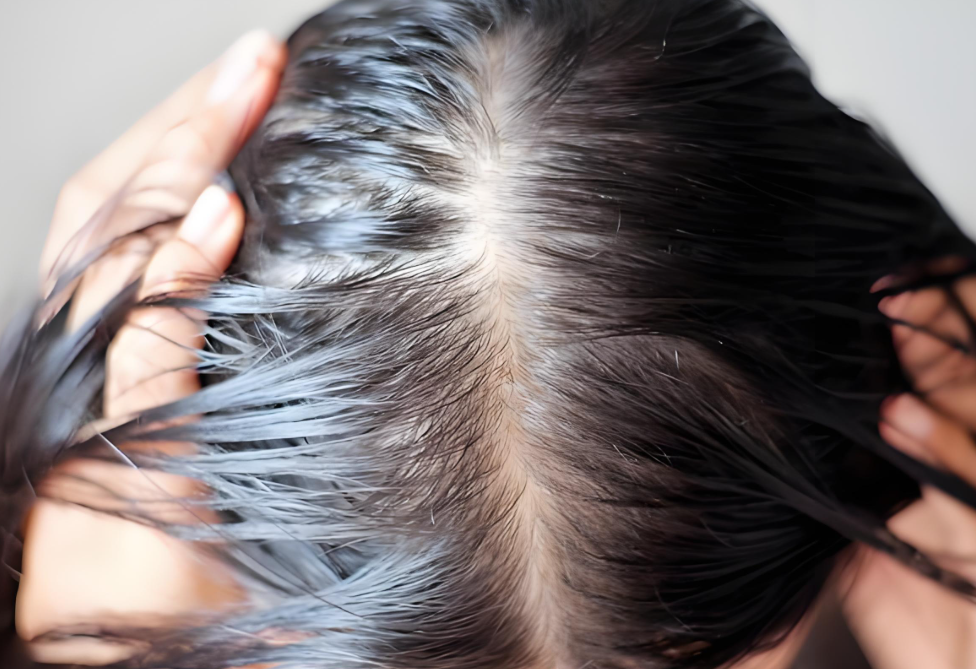 女性也会面临秃头困扰！秃头后头发还能长回来吗？