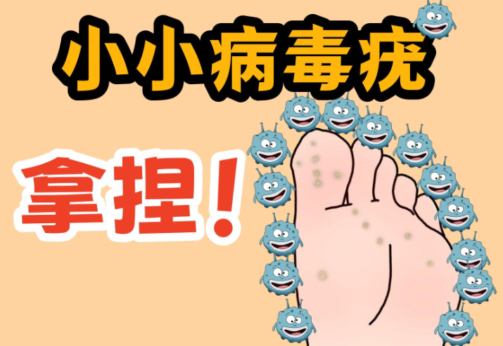 酒店光脚洗澡容易感染跖疣病毒 夏季跖疣自救指南请查收