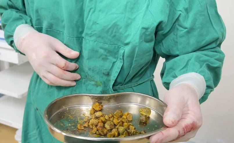 颖儿分享割胆手术经历 割胆手术后需规律饮食重视体检