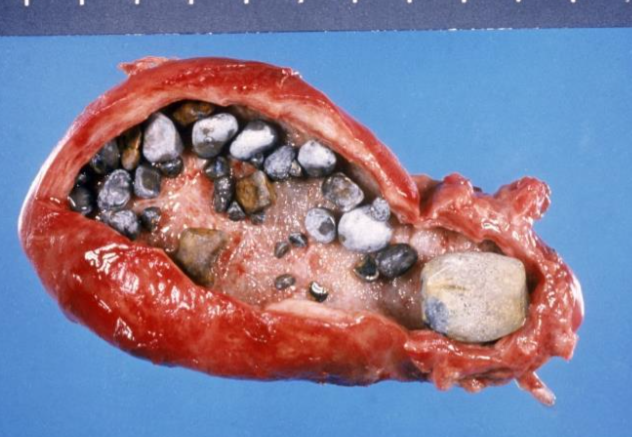 颖儿分享割胆手术经历 割胆手术后需规律饮食重视体检