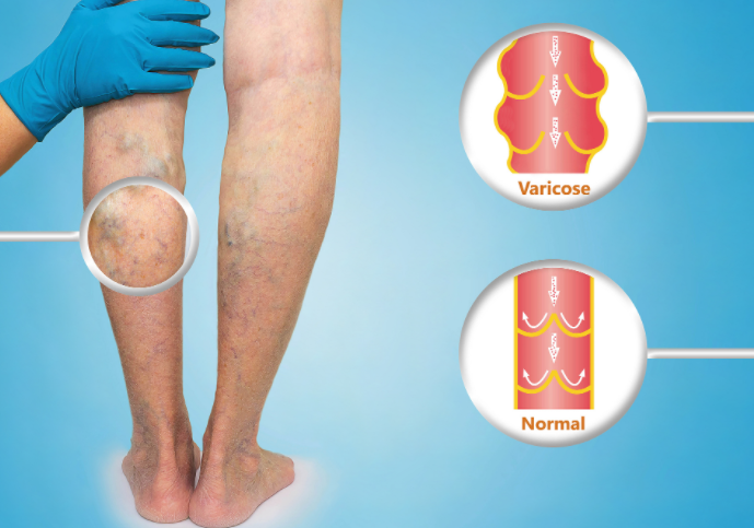 特朗普确诊静脉疾病小腿轻微肿胀 全球30%成年人都有的困扰