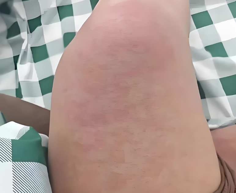 武汉出现基孔肯雅热输入病例？武汉市卫健委：将在官方渠道公开