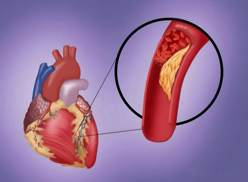 明明已经很瘦了为啥胆固醇还超标?鸡蛋吃多了容易胆固醇超标? 明明已经很瘦了为啥胆固醇还超标?鸡蛋吃多了容易胆固醇超标?