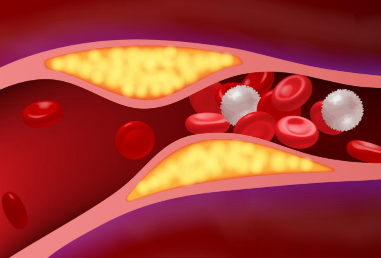 明明已经很瘦了为啥胆固醇还超标?鸡蛋吃多了容易胆固醇超标? 明明已经很瘦了为啥胆固醇还超标?鸡蛋吃多了容易胆固醇超标?