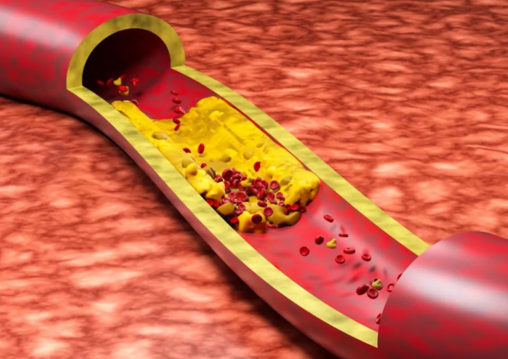 明明已经很瘦了为啥胆固醇还超标?鸡蛋吃多了容易胆固醇超标? 明明已经很瘦了为啥胆固醇还超标?鸡蛋吃多了容易胆固醇超标?