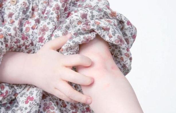 日本“苹果病”流行达历史顶点 苹果病这是什么怪病? 日本“苹果病”流行达历史顶点 苹果病这是什么怪病?