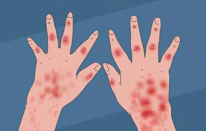 日本“苹果病”流行达历史顶点 苹果病这是什么怪病? 日本“苹果病”流行达历史顶点 苹果病这是什么怪病?