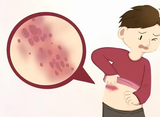 秋季带状疱疹进入高发期 秋季如何科学预防带状疱疹