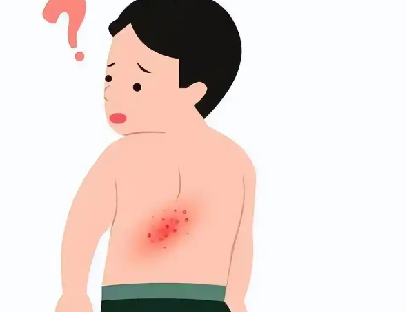 秋季带状疱疹进入高发期 秋季如何科学预防带状疱疹