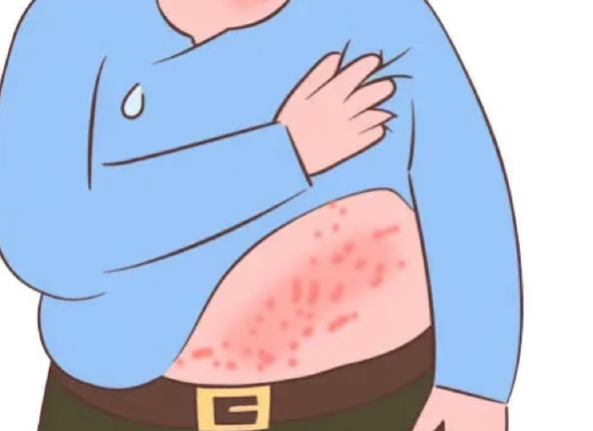 秋季带状疱疹进入高发期 秋季如何科学预防带状疱疹