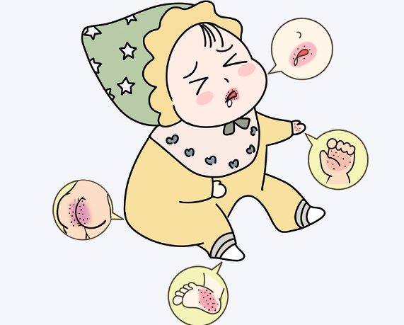 口蹄疫的治疗方法有哪些 未成年小孩如何预防口蹄疫