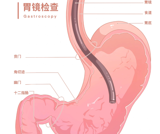 胃镜一个人去行吗 做胃镜检测需要注意什么