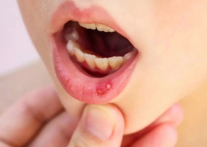 秋季口腔溃疡高发的原因(缓解口腔溃疡疼痛的5个小妙招2025) 秋季口腔溃疡高发的原因(缓解口腔溃疡疼痛的5个小妙招2025)