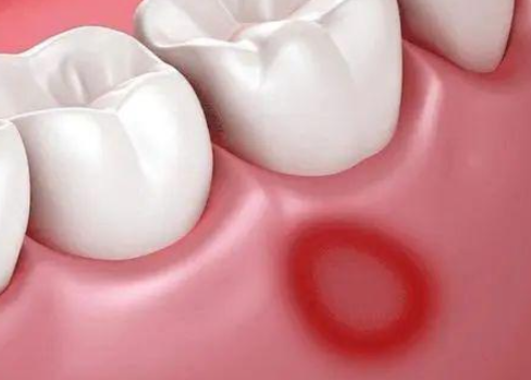 秋季口腔溃疡高发的原因(缓解口腔溃疡疼痛的5个小妙招2025) 秋季口腔溃疡高发的原因(缓解口腔溃疡疼痛的5个小妙招2025)