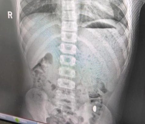 11岁孩子吞下10克万元金豆！11岁孩子为锻炼舌头吞下10克金豆