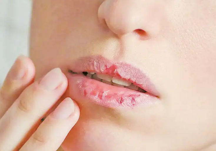 秋冬嘴唇干裂勿舔撕(2025年秋冬季唇部护理与正确保湿方法) 秋冬嘴唇干裂勿舔撕(2025年秋冬季唇部护理与正确保湿方法)