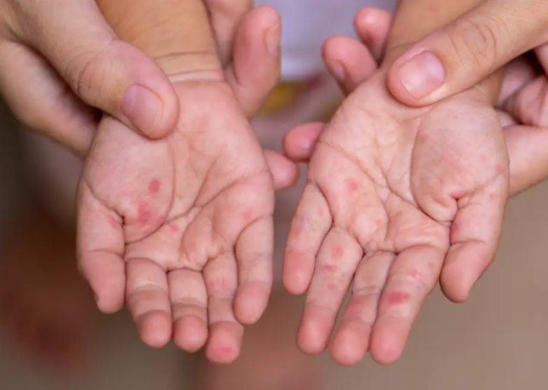 手足口病患者的饮食禁忌有哪些?小儿手足口病如何护理2025