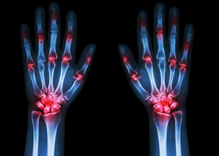 4年级小学生尿酸飙到440?痛风年轻化的真凶是谁?