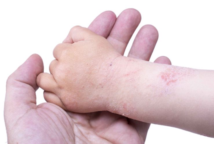 宝宝冬季皮肤干燥瘙痒？宝宝冬季皮肤干燥瘙痒护肤的黄金法则2025